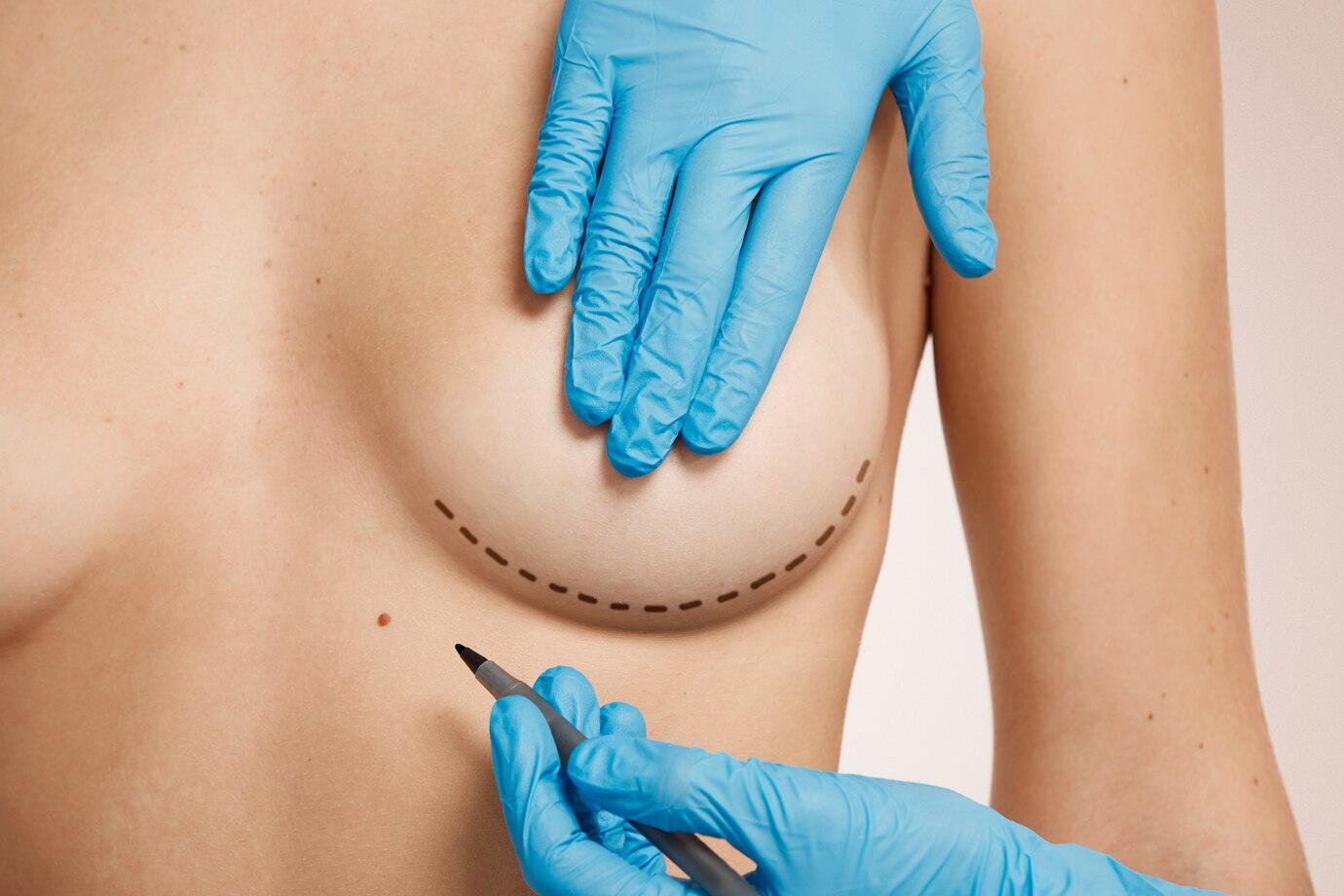 Breast Augmentation